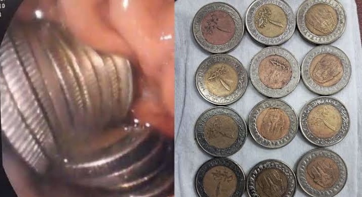مفاجأة طبية في مصر.. استخراج 13 عملة معدنية من معدة طفل 1 IMG 7086